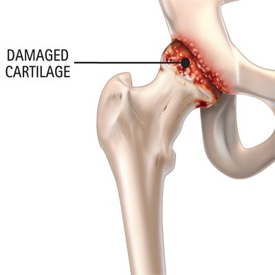 Medical illustration showing damaged cartilage of the hip