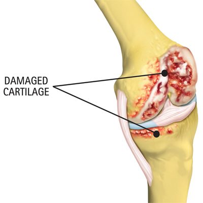 Damaged knee cartilage
