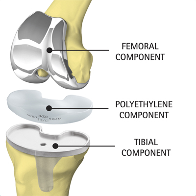 Illustration showing knee implant components - Femoral, Polyethylene and Tibial