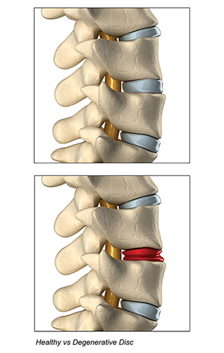 Diagram showing healthy disc vs. degenerative disc