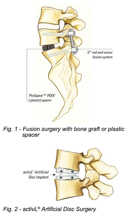 Medical illustrations showing fusion surgery with boned graft or plastic spacer vs. activL Artificial Disc surgery